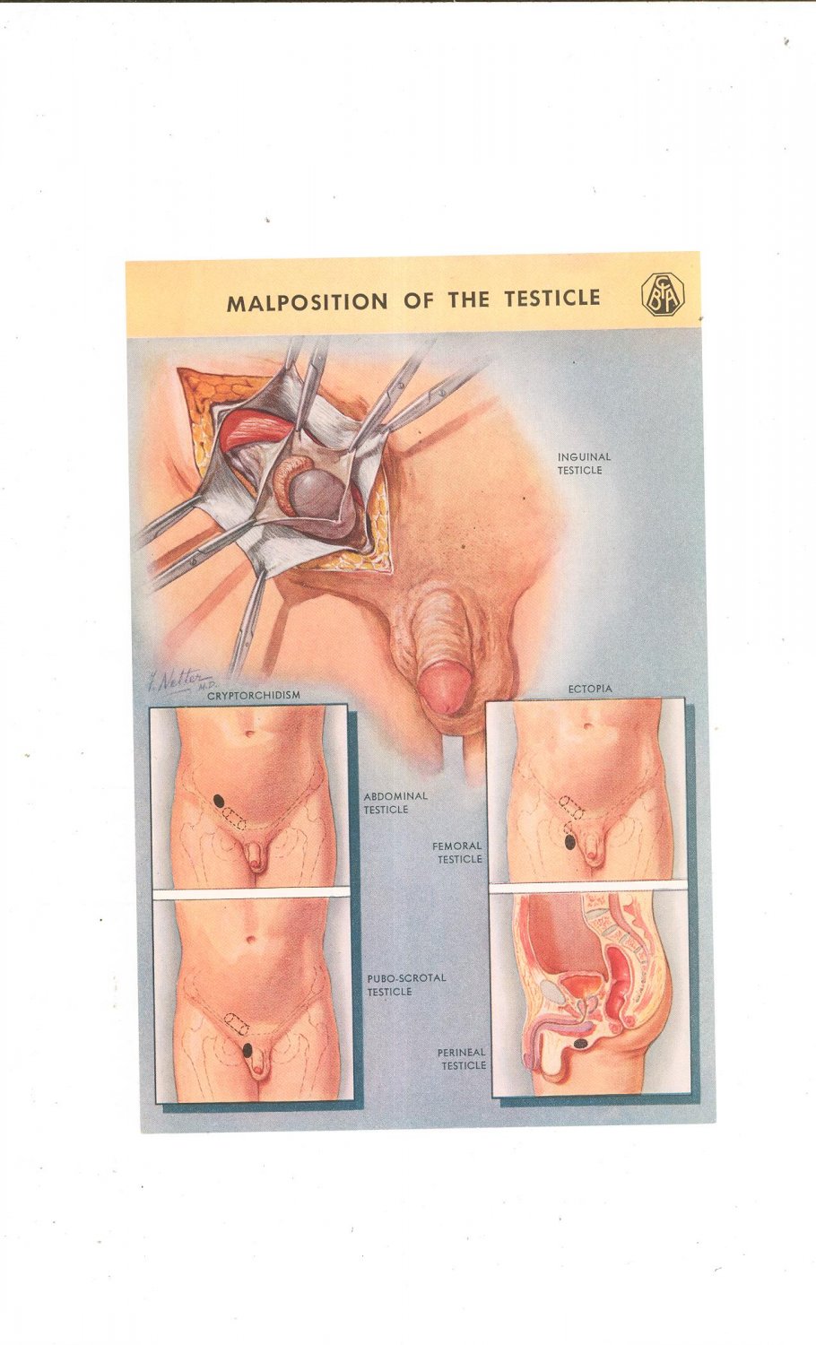 Vintage Lot of 2 Color Plates Major Anatomy And Pathology Of The Testicle Frank Netter Ciba