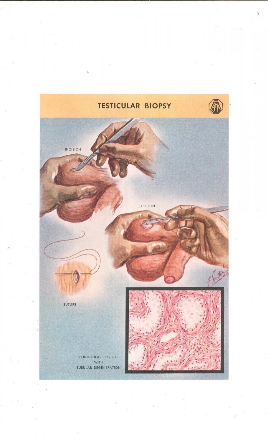 Vintage Lot of 2 Color Plates Major Anatomy And Pathology Of The Testicle Frank Netter Ciba