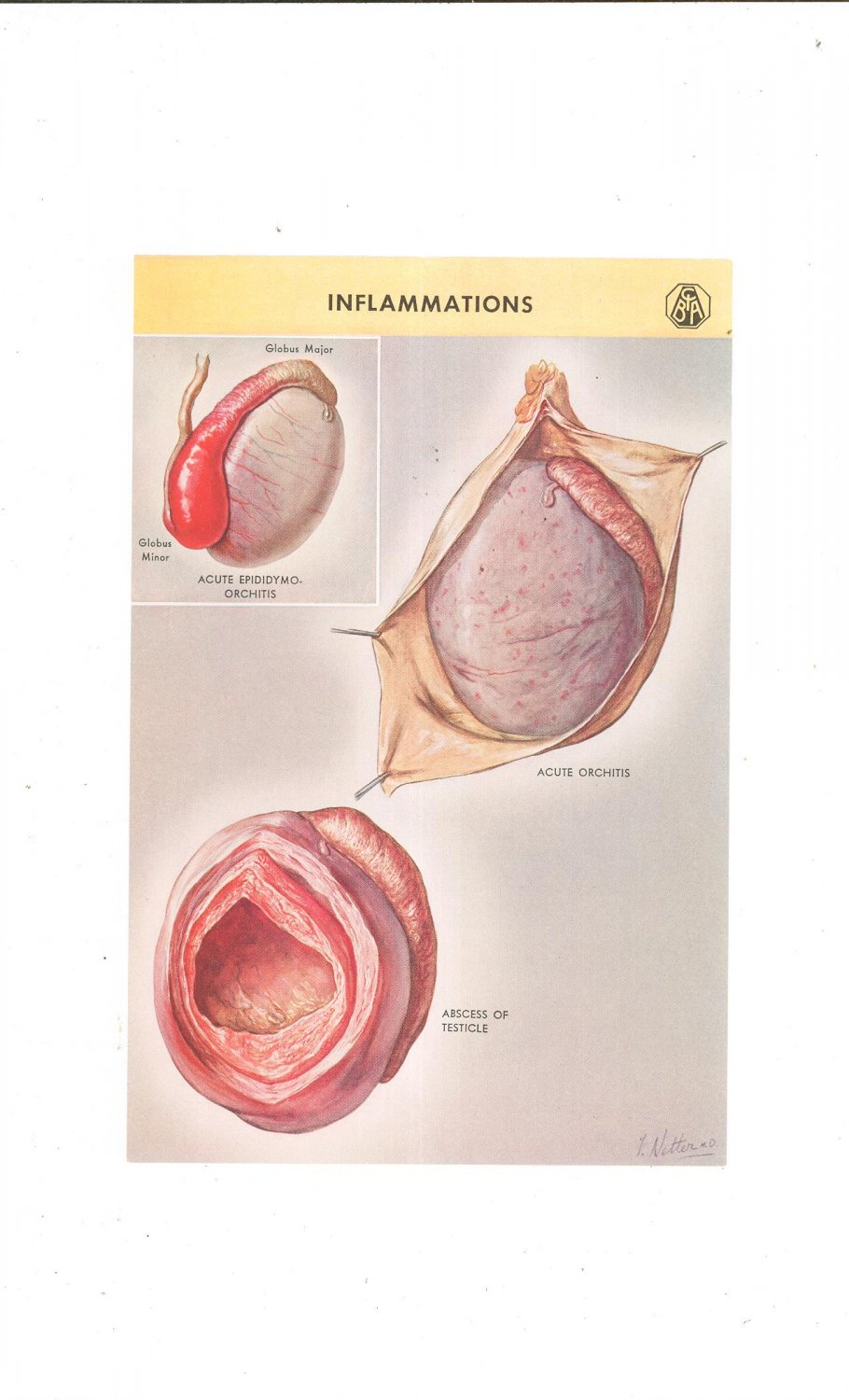 Vintage Lot of 2 Color Plates Major Anatomy And Pathology Of The Testicle Frank Netter Ciba