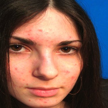 BEST ACNE TREATMENT - DON'T TREAT 1 PIMPLE AT A TIME-GET RID OF ACNE FOR GOOD
