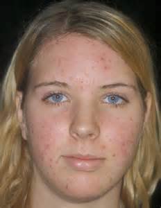 BEST ACNE TREATMENT - DON'T TREAT 1 PIMPLE AT A TIME-GET RID OF ACNE FOR GOOD