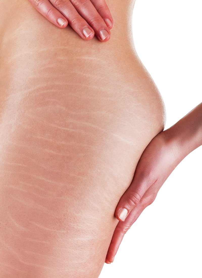 Worlds Greatest Scar & Stretch Mark Reducer / Remover