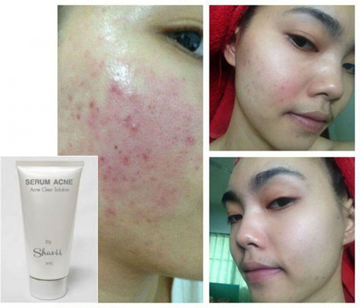 Tester 3 ml - Serum Acne Clear treatment acne - Acne Skincare