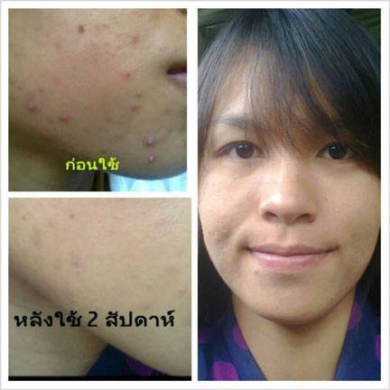 Tester 3 ml - Serum Acne Clear treatment acne - Acne Skincare