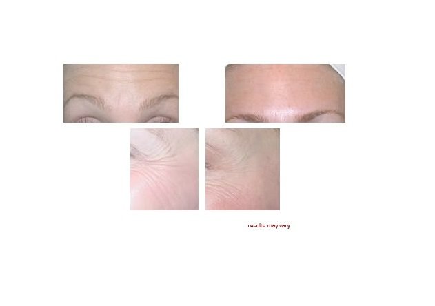Anti wrinkle serum HYALURONIC ACID HA 60% matrixyl 3000