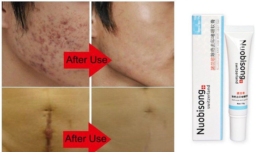Nuobisong Removal Acne Scar Stretch Marks Cream Treatment Face Care Whitening