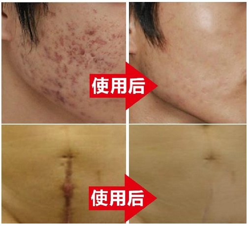 Nuobisong Removal Acne Scar Stretch Marks Cream Treatment Face Care Whitening