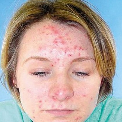 New Spot cream Gel for cystic acne pimple Clear skin face care treatment 10ml.