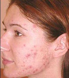 Facial Mask Acne Scars Freckle Remover Face Care Treatment Blackhead Cleansing