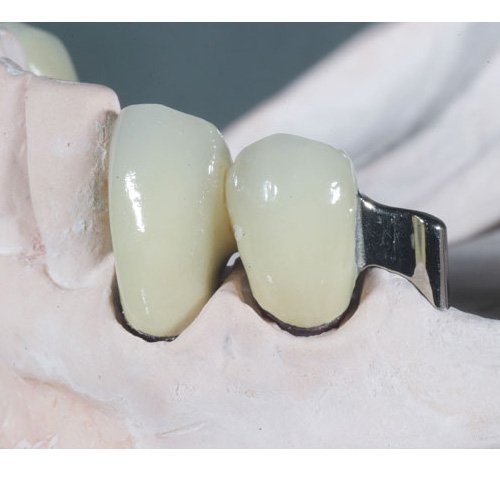Fixed Restoration Implant Crown