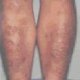 Psoriasis Treatment