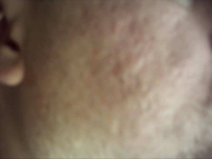 acne gone forever