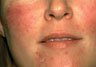 ROSACEA KIT-egyptianpearl series-OMA' certified grade A shea butter-PROVEN to HEAL skin