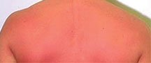 SUNBURN KIT-egyptianpearl series-with OMA' certified grade A shea butter-PROVEN to HEAL skin