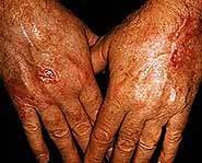 MAKOFI KIT- 5 BUTTER HAND SOFTENING KIT® AND EXFOLIATING HAND GEL shea butter, hands, nails