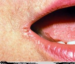 Cure Angular Cheilitis Naturally