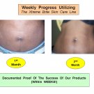 Stretch Marks Documentation Of Product Use