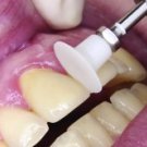 Dental OneGloss For Finishing & Polishing, Temp. Crown Removal,Ortho by SHOFU Dental OneGloss For Finishing & Polishing, Temp. Crown Removal,Ortho by SHOFU