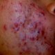Acne,Rosacea, Pimples