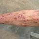 Psoriasis Treatment