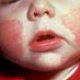 Eczema