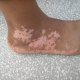 Vitiligo