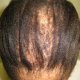 Hair Loss, Gray Hair