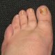 Fugus Nail, Tinea Infection