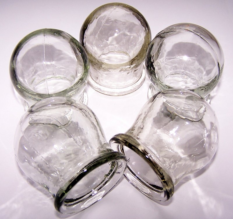 SET OF 5 GLASS MASSAGE CUPS. CHINESE MASSAGE THERAPY. NEW