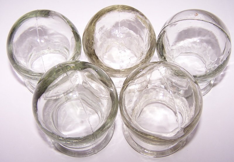 SET OF 5 GLASS MASSAGE CUPS. CHINESE MASSAGE THERAPY. NEW