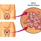 PREVENT Herpes Simplex Virus HSV-1 & HSV-2 ACYCLOVIR 5% CREAM  SALE LOT OF 3