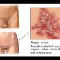 PREVENT Herpes Simplex Virus HSV-1 & HSV-2 - FOR LIPS AND BODY!