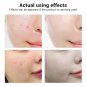 Breylee acne treatment serum