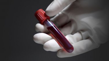 Testosterone, Total, LC/MS/MS Test