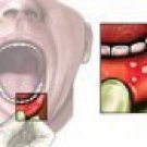 Mouth ORAL PASTE Dental For Oral Mucosa 5g