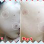 Benzac AC Water Base Gel 5% Benzoyl Peroxide Treating Acne Spots Problem 15g