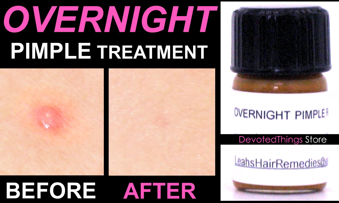 Fast Overnight Pimple Treatment for Zits, Boils, and Cysts All in 1 Remedy