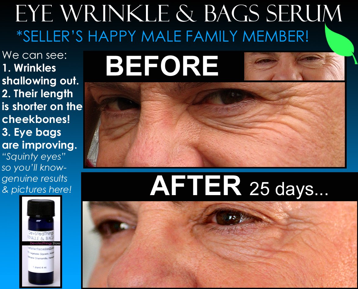 natural eye wrinkle treatment