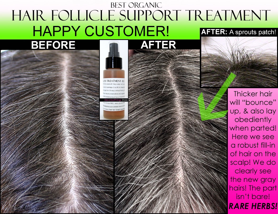 BEST ORGANIC Hair Regrowth Treatment Hair Loss Thinning Dandruff All In 1