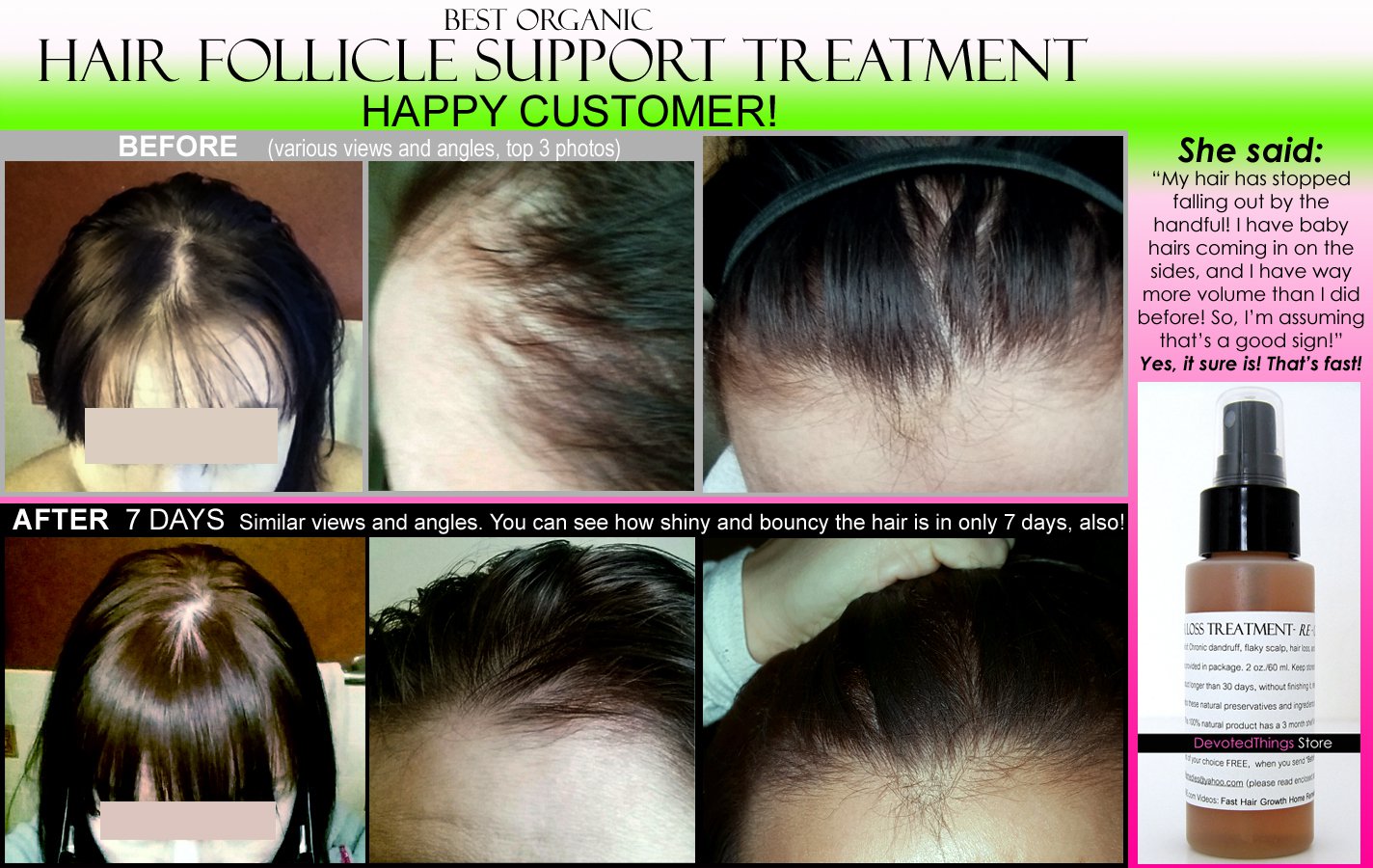 Best Organic Hair Regrowth Treatment Hair Loss Thinning Dandruff All In 1