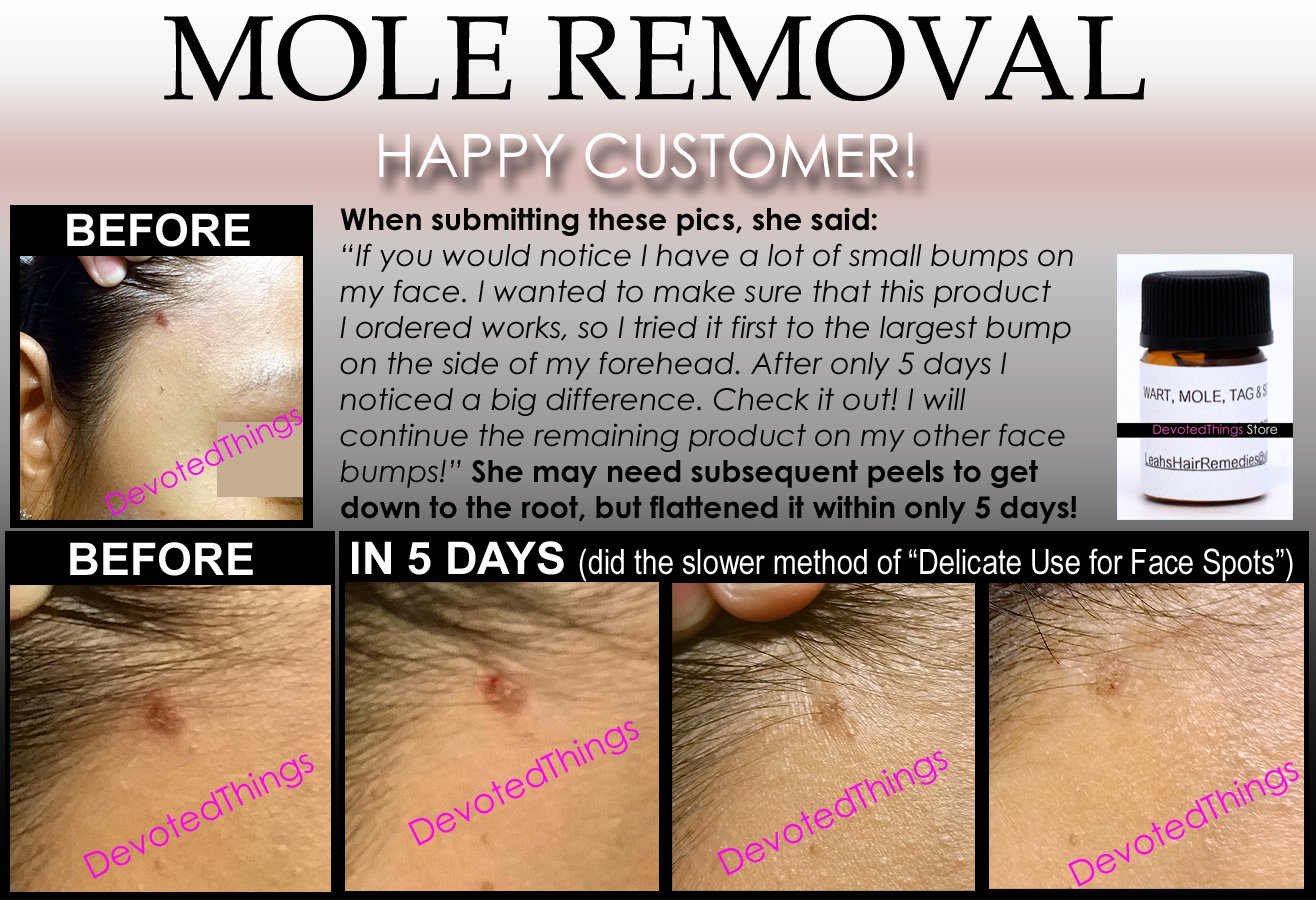 HPV Wart Remover, All Warts, Mole, Skin Tag, Keloid Scar ALLIN1