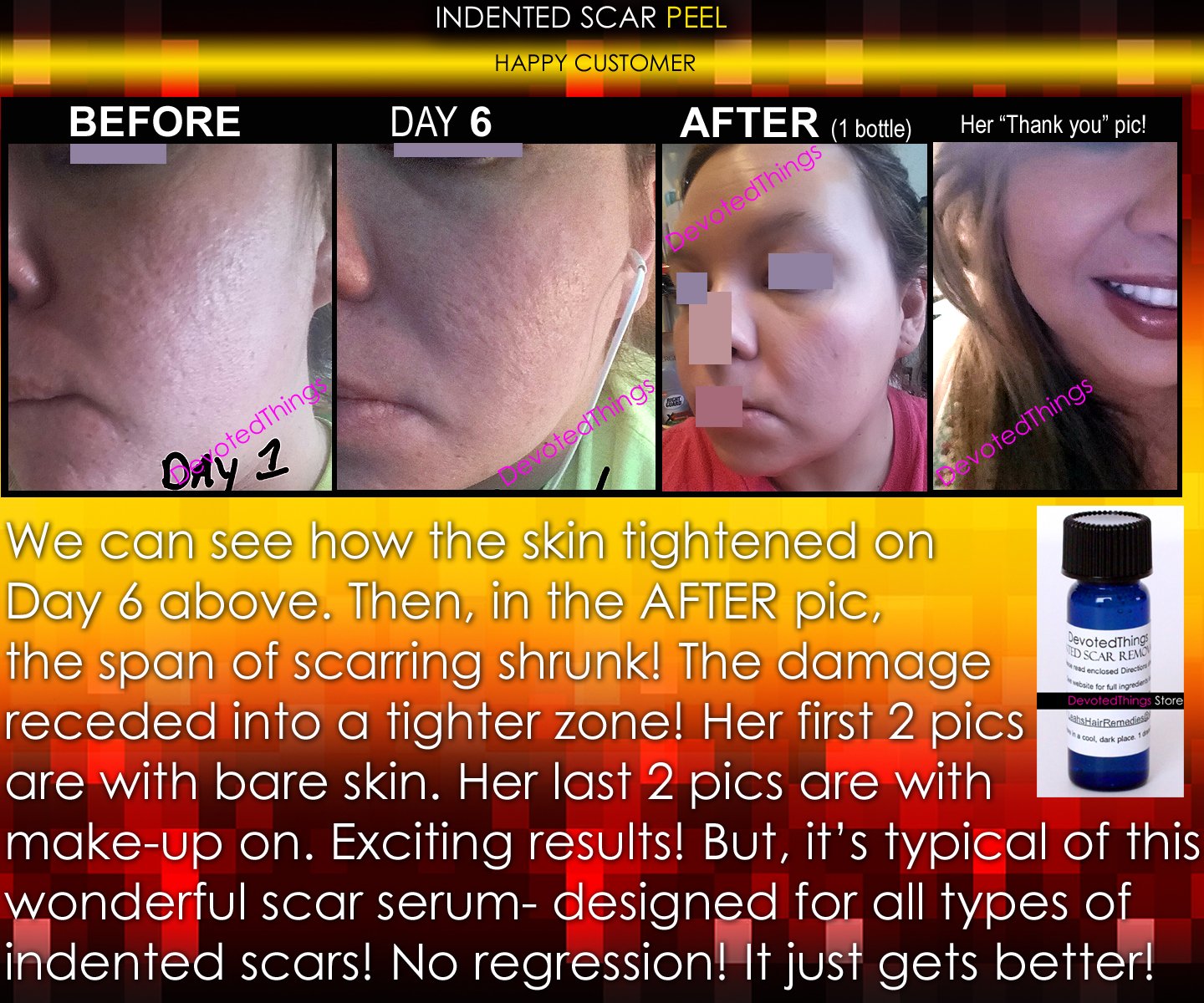 BEST Treatment for Indented Scars Acne Chicken Pox Pitted Scar Removal