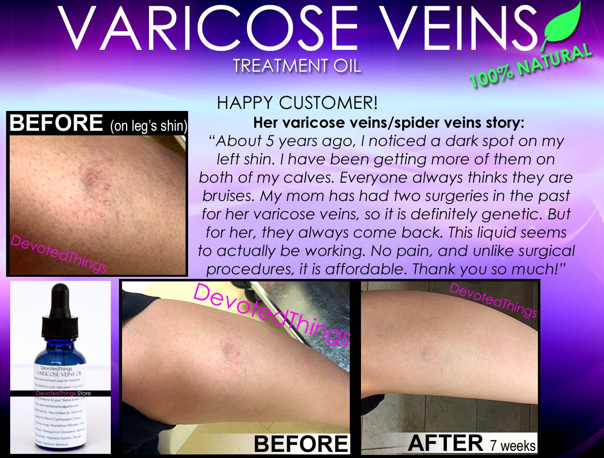 NATURAL VARICOSE VEIN TREATMENT AND SPIDER VEIN TREATMENT 2 IN 1 