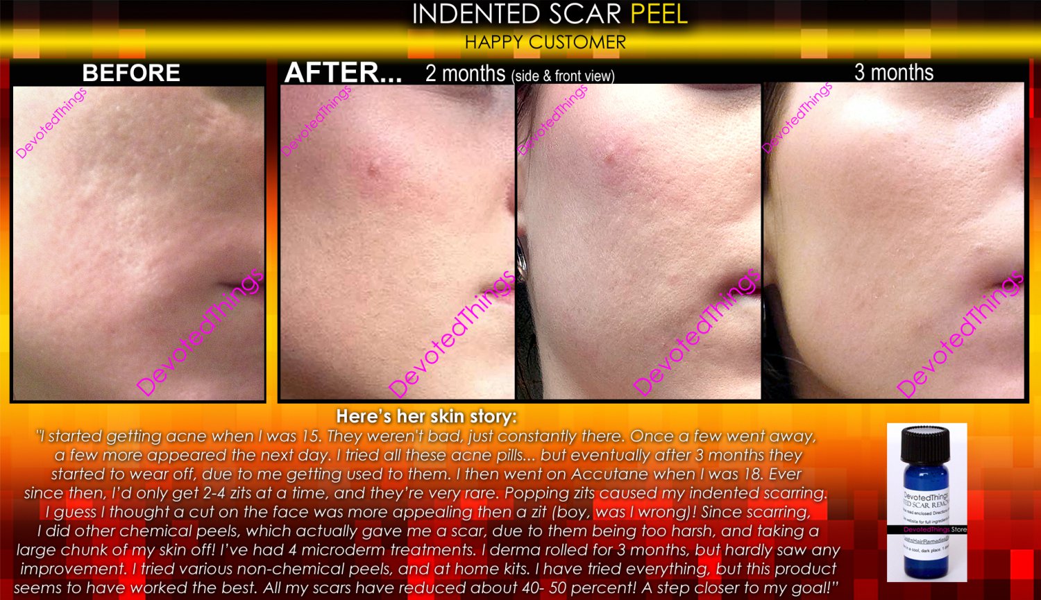 BEST Treatment For Indented Scars Acne Chicken Pox Pitted Scar Removal 