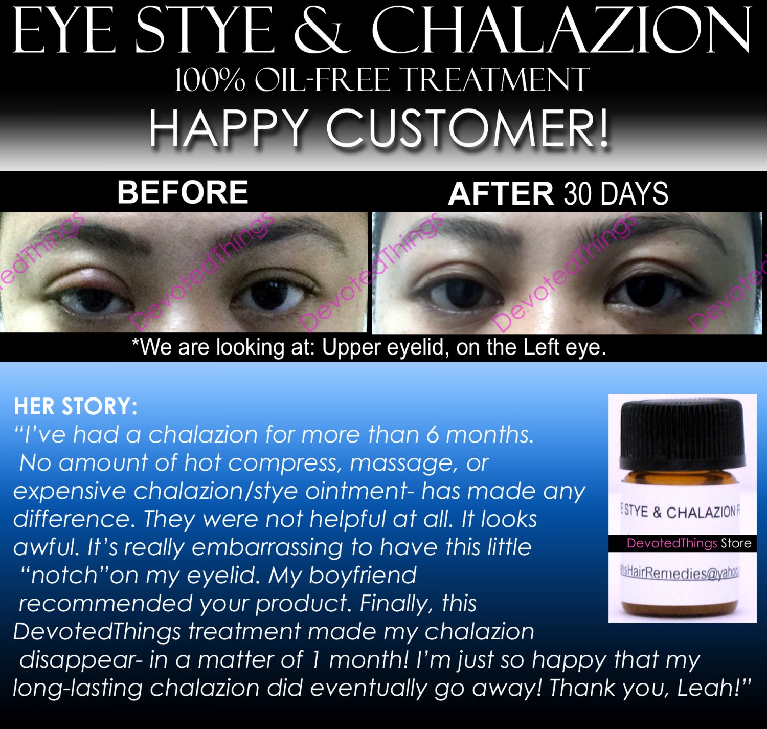 Best Eye Stye And Chalazion Product 2 In 1 Oil Free 