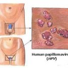 Wart Remover – Wart Remover, Skin Tag, Mole – 10ml