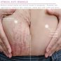 Mango cream for Pregnancy ,Scars Acne, Remove Stretchs Marks Treatment Maternity