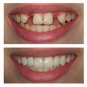 Dent-Sure Temporary Tooth Replacement System - 24 pc