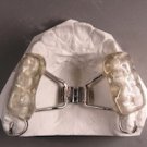 Bonded Rapid Palatal Expander