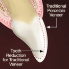 Fixed Restoration Lumineers Veneers